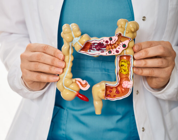 Treatment of colitis, flatulence, indigestion in healthcare. Anatomical intestines model with pathology in doctor hands, close-up